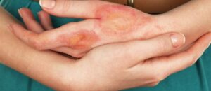 علاج الحروق بطرق طبيعية